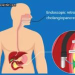 ERCP For Jaundice %E2%80%93 Is It Helpful