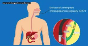 ERCP For Jaundice – Is It Helpful? 1 ERCP For Jaundice – Is It Helpful?