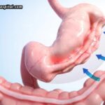 Who Is A Good Candidate For Endoscopic Sleeve Gastroplasty