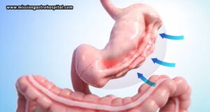 Who Is A Good Candidate For Endoscopic Sleeve Gastroplasty?