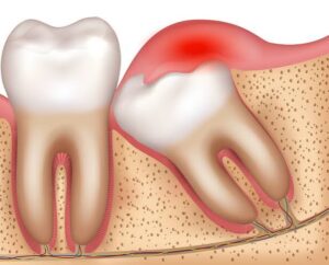 What Happens If You Don’t Remove Your Wisdom Teeth?