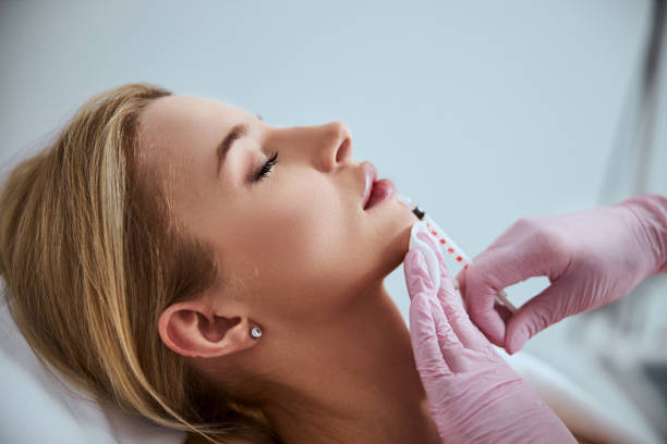 Russian Lip Fillers in Dubai 14