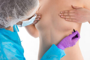 Comparing Silicone Breast Implant Shapes and Textures