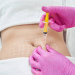 What Happens to Fat Cells After Fat Melting Injections? 3 What Happens to Fat Cells After Fat Melting Injections?