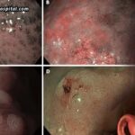 How NBI Endoscopy Improves Digestive Tract Abnormality Detection