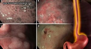 How NBI Endoscopy Improves Digestive Tract Abnormality Detection