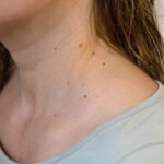 Mole Removal in Riyadh 23