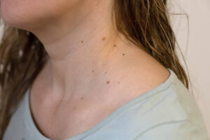 How to Tell If a Mole Needs Medical Assessment or Removal