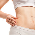 How Liposuction Can Enhance Your Natural Body Shape