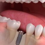 Dental Implant Healing Timeline: What to Expect Week by Week!