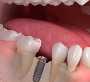 Dental Implant Healing Timeline: What to Expect Week by Week! 1 Dental Implant Healing Timeline: What to Expect Week by Week!