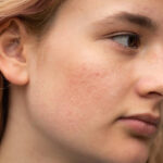 How Collagen Stimulation Helps Improve Acne Scars
