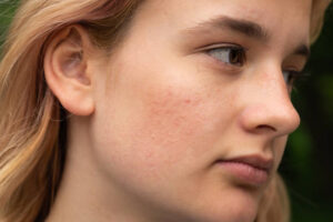 How Collagen Stimulation Helps Improve Acne Scars
