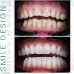 Cosmetic Dentistry & Smile Design in Juhu, Mumbai