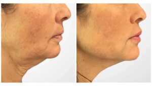 Best Aesthetic Clinic in Dubai: Effective Skin Lifting Thread Lift