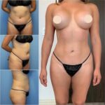 Liposuction pictures 1