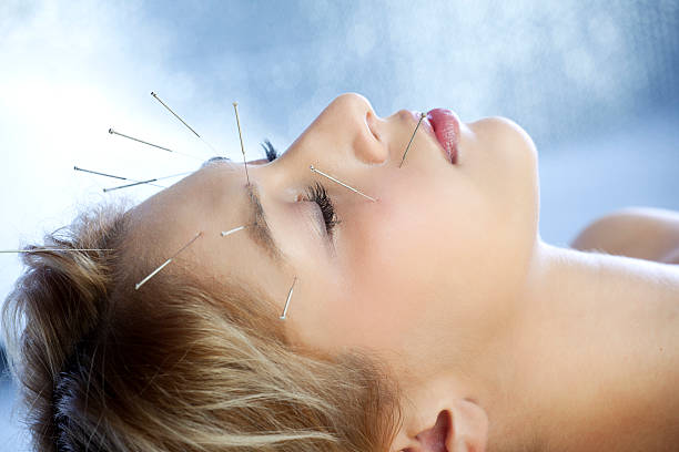 Acupuncture Treatment in Dubai 2
