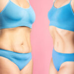 Tummy Tuck in Riyadh 13