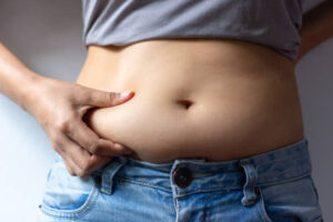 Tummy Tuck Surgery for Post-Weight Loss Patients: What to Know 1 Tummy Tuck Surgery for Post-Weight Loss Patients: What to Know