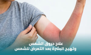 أفضل واقي بعد الشمس لتهدئة البشرة: كيف تعتني ببشرتك بعد التعرض للشمس؟ 1 أفضل واقي بعد الشمس لتهدئة البشرة: كيف تعتني ببشرتك بعد التعرض للشمس؟