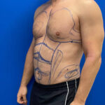 Does Liposuction remove stubborn fat for a sleek silhouette glow?