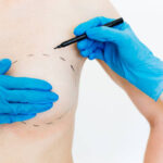Silicone Breast Implants: Impact on Mammograms and Imaging 3 Silicone Breast Implants: Impact on Mammograms and Imaging