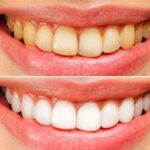 Can Yellow Teeth Become White Again? A Guide to Teeth Whitening in Kothrud