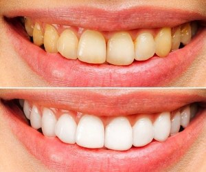 Can Yellow Teeth Become White Again? A Guide to Teeth Whitening in Kothrud 1 Can Yellow Teeth Become White Again? A Guide to Teeth Whitening in Kothrud