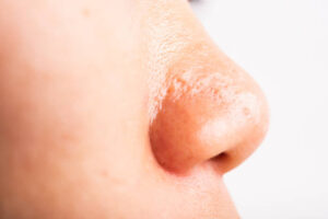 Alarplasty Technique Guide: Matching Method to Facial Harmony 1 Alarplasty Technique Guide: Matching Method to Facial Harmony