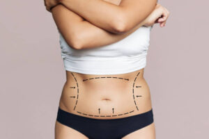 How to Manage Swelling After Liposuction 1 How to Manage Swelling After Liposuction