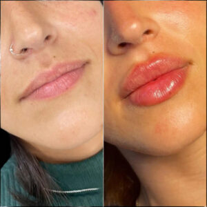 Best Plastic Surgeons in dubai for Modern Aesthetic Dermal Fillers 1 Best Plastic Surgeons in dubai for Modern Aesthetic Dermal Fillers
