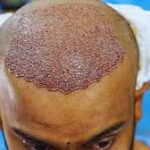 Hair Transplant Manchester: A Complete Guide to Choosing the Right Hair Restoration Clinic 3 Hair Transplant Manchester: A Complete Guide to Choosing the Right Hair Restoration Clinic