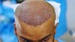 Hair Transplant Manchester: A Complete Guide to Choosing the Right Hair Restoration Clinic 1 Hair Transplant Manchester: A Complete Guide to Choosing the Right Hair Restoration Clinic