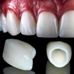 How Can a Dental Crown Restore a Broken Tooth and Protect Your Smile?