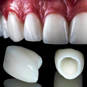 How Can a Dental Crown Restore a Broken Tooth and Protect Your Smile?