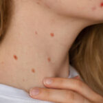 Mole Removal in Riyadh 21