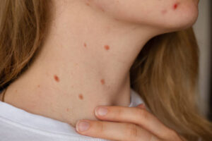 Mole Removal Recovery: A Step-by-Step Healing Guide 1 Mole Removal Recovery: A Step-by-Step Healing Guide