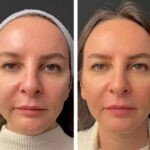 Mesotherapy in Dubai 1