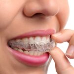 Mouth Guards in Dubai5