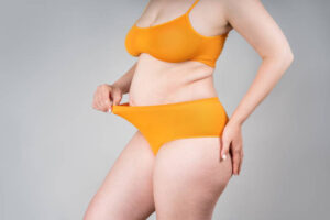 What Determines the Right Tummy Tuck Technique for Each Patient? 1 What Determines the Right Tummy Tuck Technique for Each Patient?