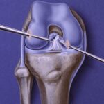 ACL Repair 1024x959 1