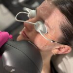 What Is the Downside of IPL Treatment