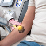 Laser Tattoo Removal in Riyadh 13