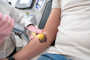 How Long Does It Take to See Results From Laser Tattoo Removal? 1 How Long Does It Take to See Results From Laser Tattoo Removal?