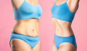 Tummy Tuck in Riyadh: Exploring Contemporary Cosmetic Procedures 1 Tummy Tuck in Riyadh: Exploring Contemporary Cosmetic Procedures