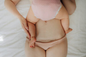 Breast Reduction and Mommy Makeover: When Is It Considered?