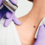 Mole Removal in Dubai 8