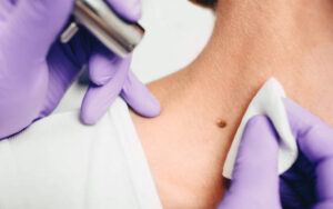 How Is Mole Removal in Dubai Chosen for Different Mole Types?