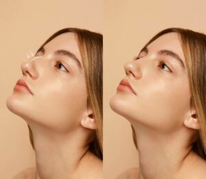 7 Realities of Rhinoplasty Before and After Transformation 1 7 Realities of Rhinoplasty Before and After Transformation
