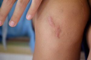 What Questions Should You Ask Before Keloid Treatment? 1 What Questions Should You Ask Before Keloid Treatment?